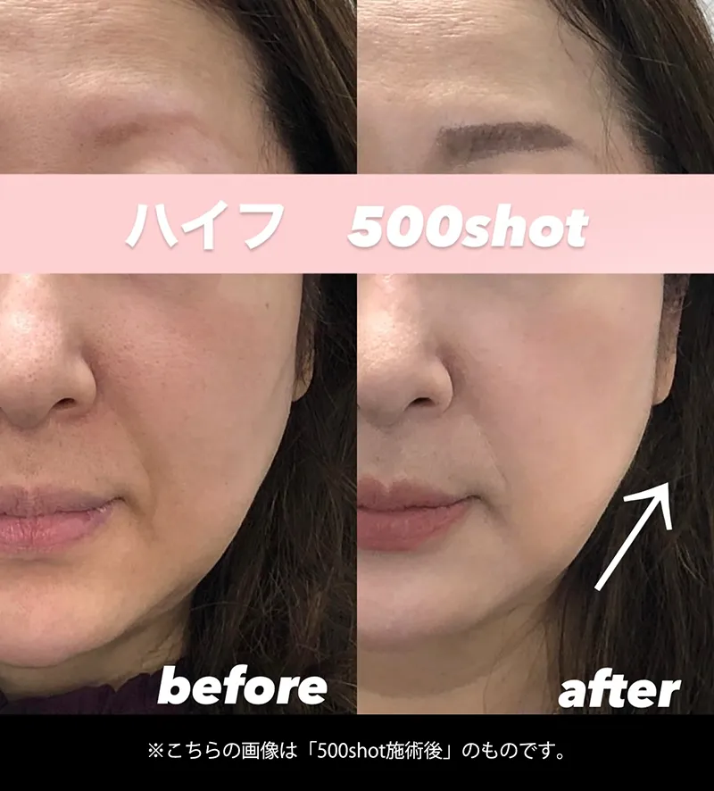 ハイフ400shotの施術[before/after]